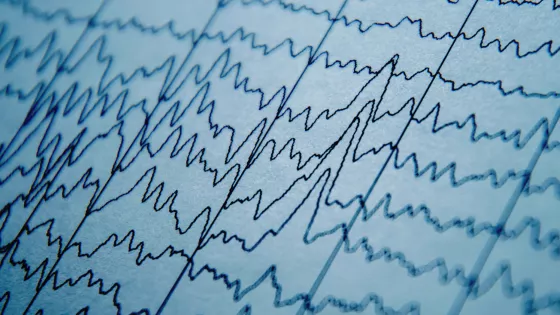 Photograph of brain wave patterns on an EEG of a pediatric patient